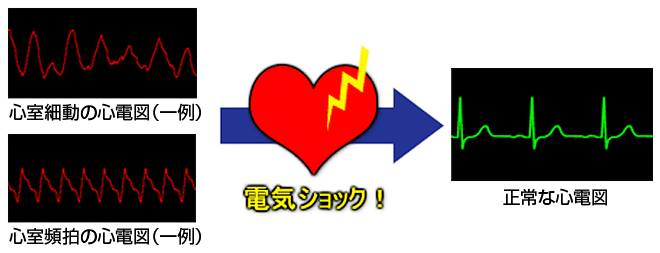 AEDによる回復例(心電図)